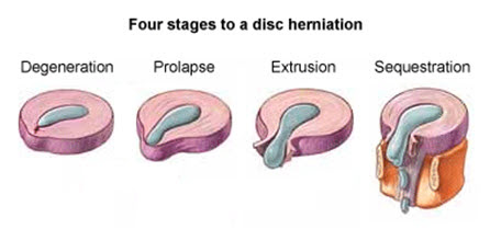 disc herniation pain, bloomington il chiropractor