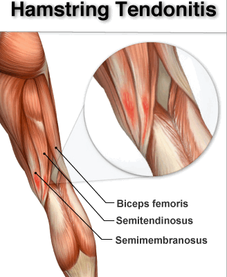 Hamstring muscles pain