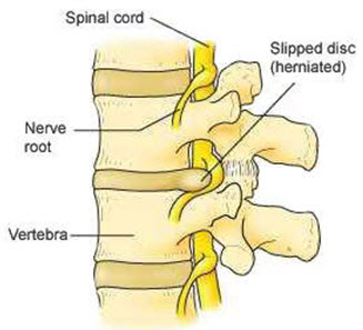 slipped disc, back pain, neck pain